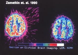 varredura clínica de imagens cerebrais para TDAH