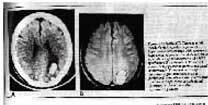 Hemorragia intracerebral após terapia eletroconvulsiva (ECT)